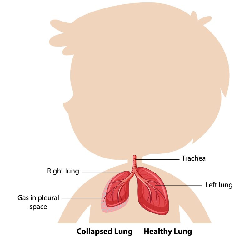 Pneumothorax diagram of human anatomy