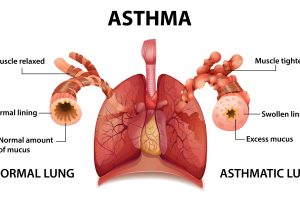 Human anatomy Asthma diagram illustration
