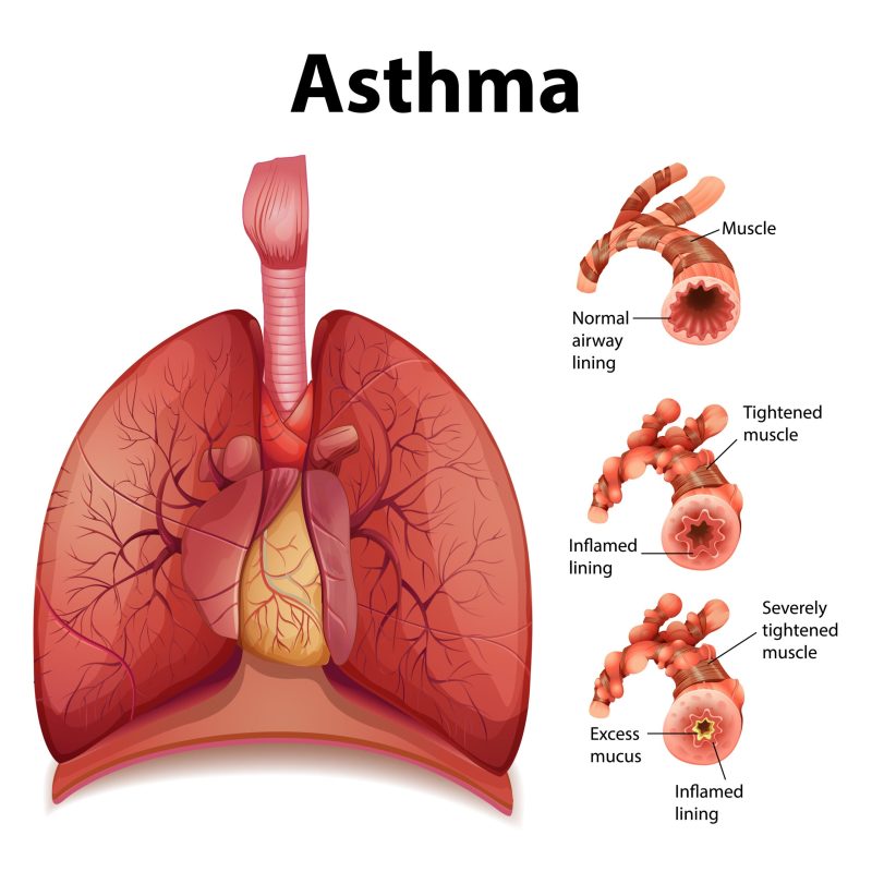 Comparison of healthy lung and Asthmatic lung