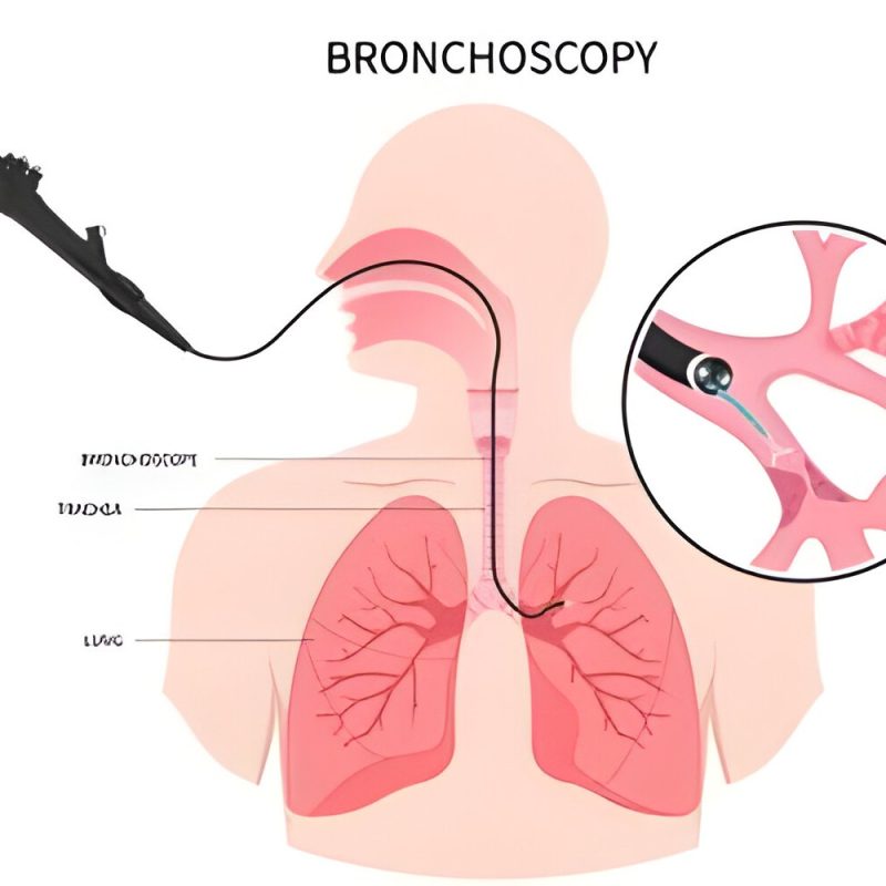 Bronchoscopy