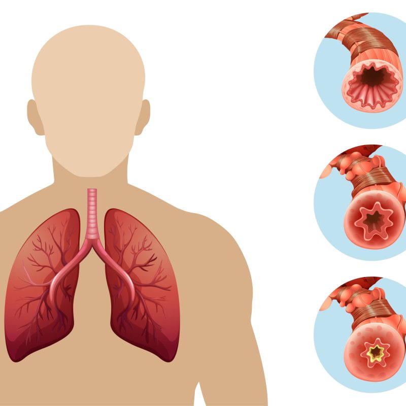 Diagram showing chronic obstructive pulmonary disease